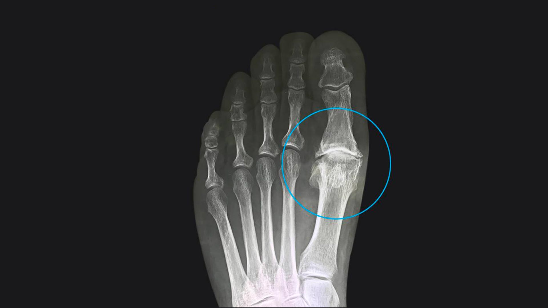 Alluce valgo | patologia del piede